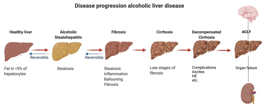 Cirrhosis and ACLF - A-TANGO